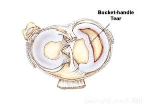 Horizontal Degenerative A Complex Tear Includes More Than One Pattern