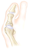 Image of Chevron Procedure