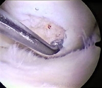 Cartilage defects